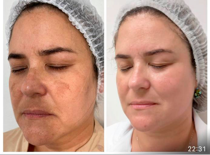 Tratamento para Melasma Antes e Depois