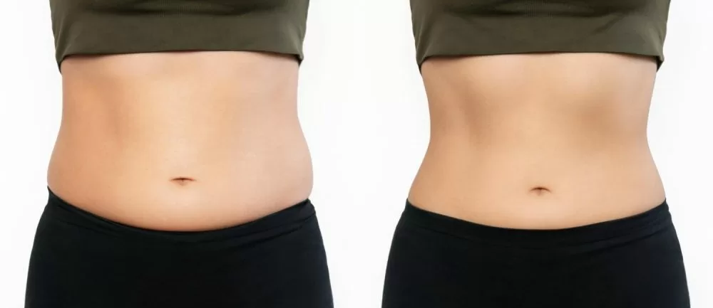 Hidrolipo (não aspirativa)